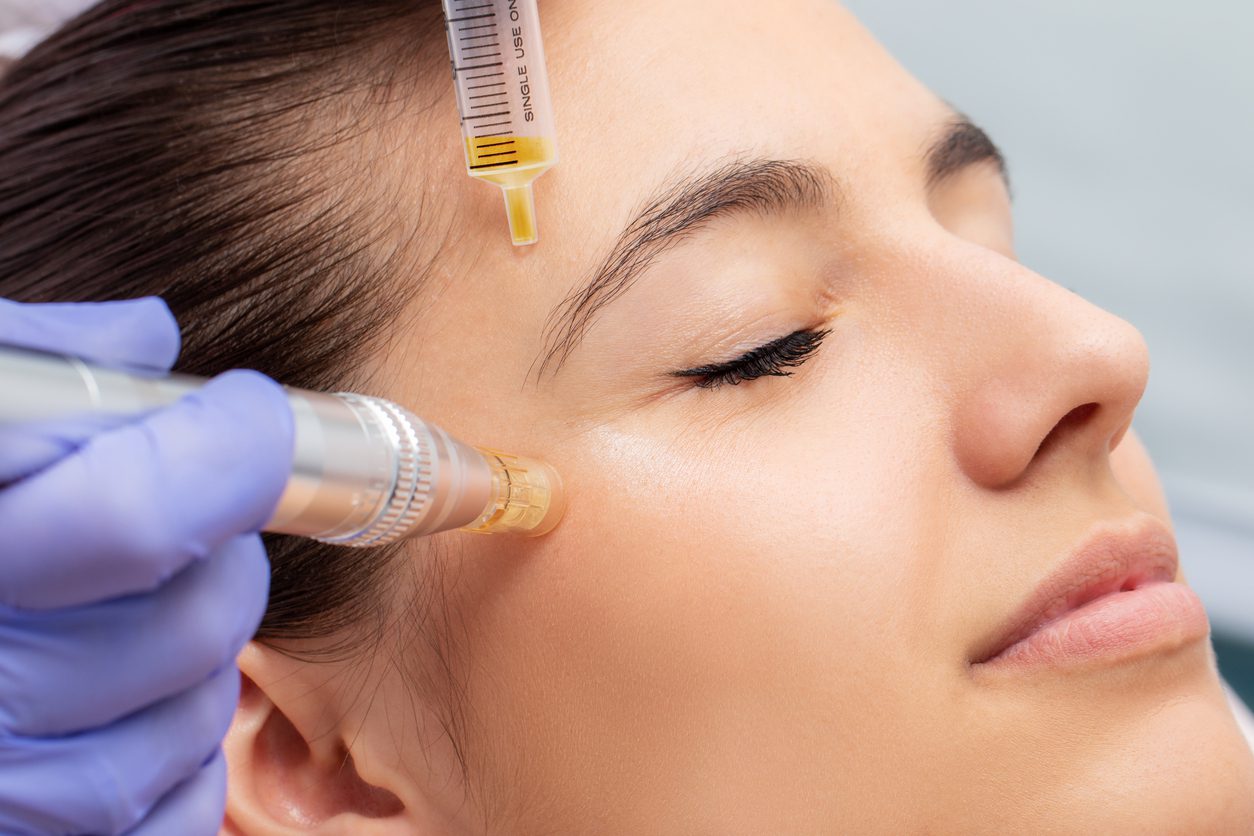 Macro close up of therapist injecting enzymes and with derma pen around woman's eyes.